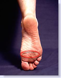 sore feet after heels